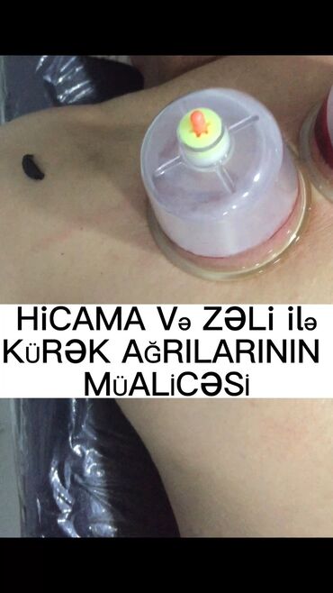 Hicama, zəli: Hicamanın Faydaları✅ *Qan dövranın pozulması *Qanın təmizlənməsi — 6