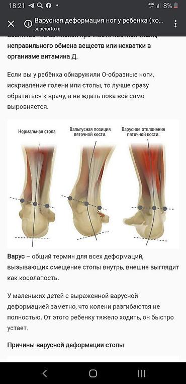 артапический обувь: Алтын батек адамдын болгон 207 соогун туздоп 1_артрит,моноартрит — 8