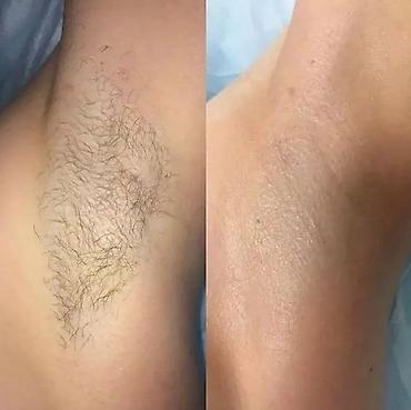 Эпиляция: ТОЛЬКО ДЛЯ ЖЕНЩИН Шугаринг и восковая депиляция Услуга — 7