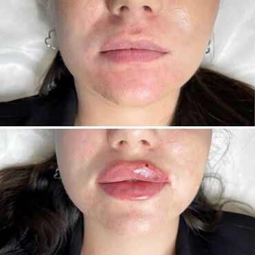 оборудование салон красоты: Косметолог | Увеличение губ | Консультация, Гипоаллергенные материалы