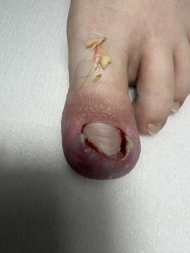 Маникюр: Коррекция вросших ногтей, Услуги подолога, Одноразовые расходные материалы — 6