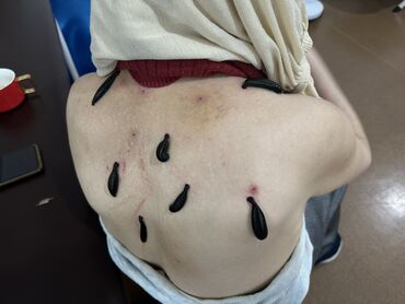 Hicama, zəli: Xidmət: Kupa terapiyası (quru və yaş/hicama), bel–boyun–çiyin masajı — 18