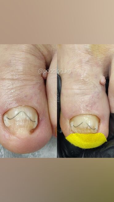 Маникюр, педикюр: Коррекция вросших ногтей, Маникюр, Педикюр, Услуги подолога, Консультация, Одноразовые расходные материалы — 11