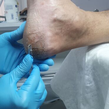 Маникюр, педикюр: Коррекция вросших ногтей, Маникюр, Педикюр, Услуги подолога, Консультация — 18