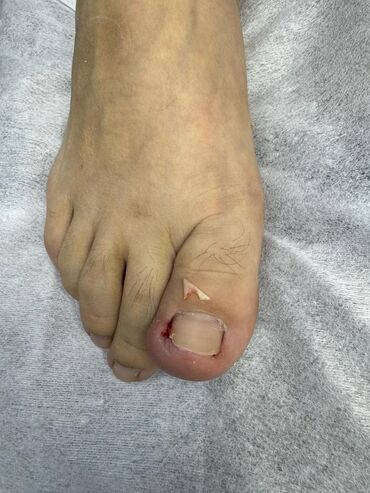 Маникюр, педикюр: Вросший ноготь. Коррекция вросшего сегмента путем удаления врастающих — 10