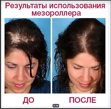 для роста волос: АППАРАТ ОТ ОБЛЫСЕНИЯ И НЕ ТОЛЬКО МНОГО ВИДОВ ВСЕ В ТЕМЕ читаем — 4