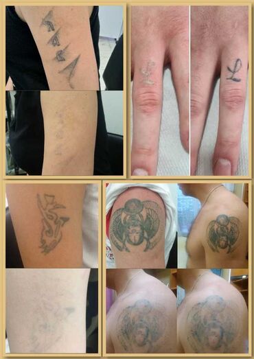 tattoo sekilleri: Tatu, pirsinq | Tatuların silinməsi