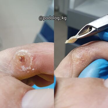 Маникюр, педикюр: Коррекция вросших ногтей, Маникюр, Педикюр, Услуги подолога, Консультация — 16