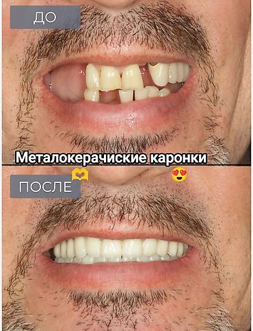 Стоматологи: Съёмные зубные протезы под ваши задачи - Вакуумные протезы: плотная — 5
