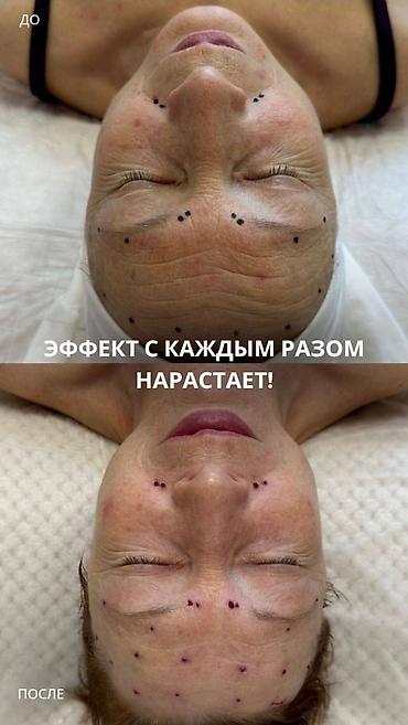 Косметология: Косметология, Пилинг, Демодекоз, Лифтинг, Консультация, Сертифицированный косметолог, Гипоаллергенные материалы — 18