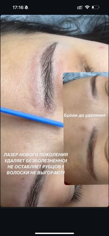 Перманентный макияж: АКЦИЯ !АКЦИЯ! Новый метод удаления Сейчас по акции Лазерное удаление — 7