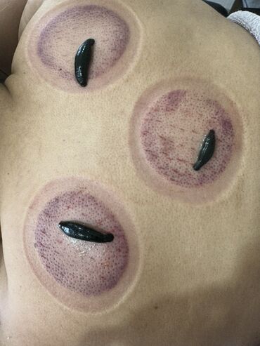 Masaj: Vakuum masajı, Qadınlar üçün — 10