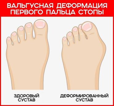165 объявлений | lalafo.kg: Корректоры для большого пальца ноги от вальгусной деформации(косточки