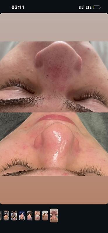 Красота и здоровье: Профессиональная мужская чистка лица в Derma Clinic - Акция — 2