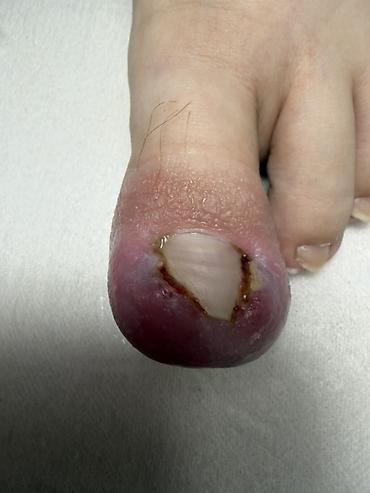 Маникюр: Коррекция вросших ногтей, Услуги подолога, Одноразовые расходные материалы — 3