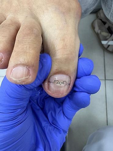 Маникюр: 📢акция с ! Вросший ноготь 📍подологический педикюр,👣 📍мозоли — 11