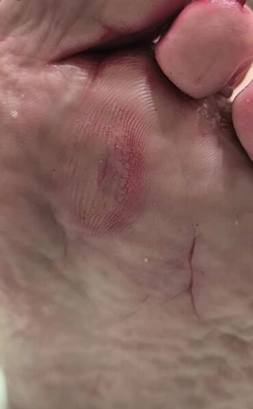 Маникюр, педикюр: Коррекция вросших ногтей, Педикюр, Услуги подолога, Консультация, Одноразовые расходные материалы — 2