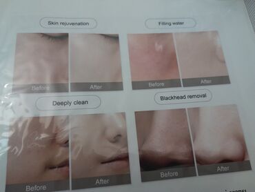 Kosmetoloji aparatlar: Darsonval, Pilinq, Brosaj, Üz üçün, Dəri üçün, Bədən üçün — 11