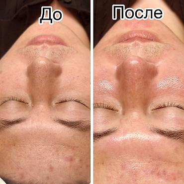 лазерный эпиляция: Лазерная эпиляция в Бишкеке - Диодный лазер премиум‑класса последнего — 5