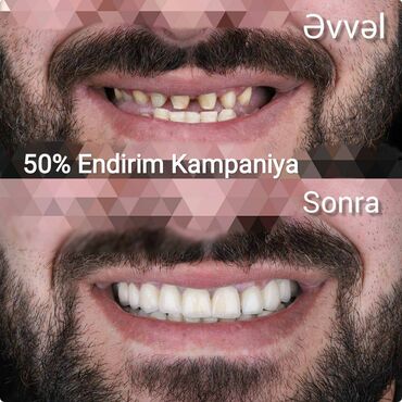protez saç bakida qiymeti: Стоматология | Керамика, Пломбирование, Восстановление сломанных зубов | Кредит