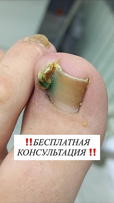 мазоли: Профессиональный подологический уход за стопами и ногтями ‼️бесплатная — 1