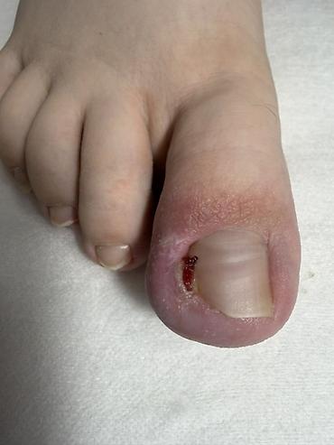 Маникюр: Коррекция вросших ногтей, Услуги подолога, Одноразовые расходные материалы — 9