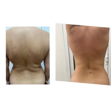 Hicama, zəli: Xidmət: Kupa terapiyası (quru və yaş/hicama), bel–boyun–çiyin masajı — 6