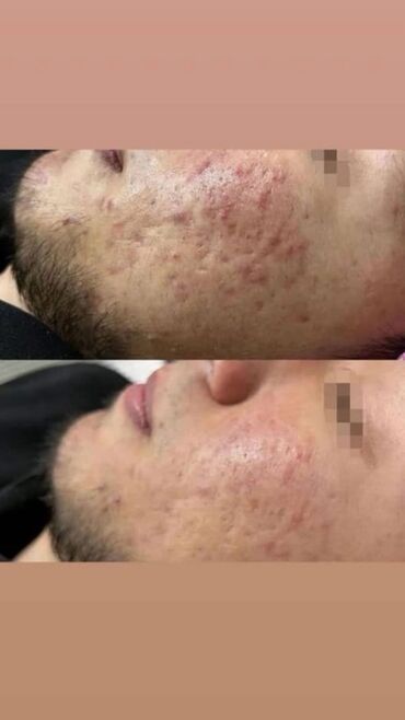 удаление татуажа лазером цена: Косметология, Терини тазалоо, Консультация, Гипоаллергендик материалдар, Сертификаты бар косметолог