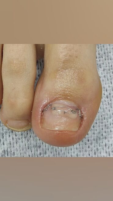 Маникюр, педикюр: Коррекция вросших ногтей, Маникюр, Педикюр, Услуги подолога, Консультация, Одноразовые расходные материалы — 8