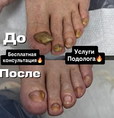 натижное паталок фото: Коррекция вросших ногтей, Услуги подолога, Консультация — 1