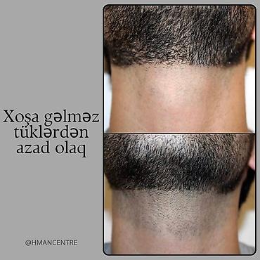 Xidmətlər: 💥Kişilər üçün Lazer Epilasiya💥 Üz,Boyun,Boğaz,Qulaq,Burun = 15 AZN — 10