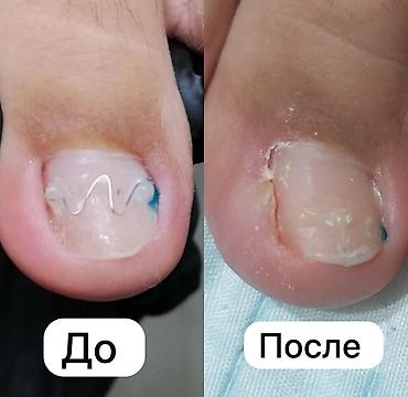Коррекция вросшего ногтя без операции - Установка ортонексической at lalafo.kg Коррекция вросшего ногтя без операции - Установка ортонексической