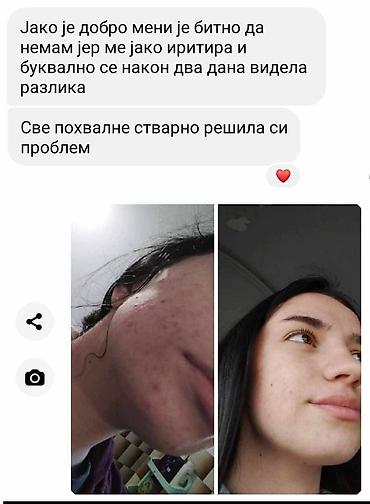 Nega kože: Aknelim gel 30ml – 100% delotvoran saveznik protiv akni Iskoristite — 7