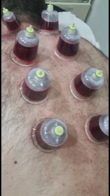 Hicama, zəli: Bəylər üçün = Hicama Və Zəli ✅Zəlinin Faydaları(Hirudoterapiya) — 6