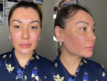 Косметология: Косметология, Биоревитализация, Ботокс, Ботулинотерапия, Требуются модели, Гипоаллергенные материалы, Консультация — 3