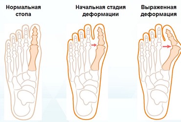 растёт косточка на ноге: Корректоры для большого пальца ноги от вальгусной деформации(косточки