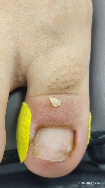 Маникюр, педикюр: Коррекция вросших ногтей, Маникюр, Педикюр, Услуги подолога, Консультация, Одноразовые расходные материалы — 4