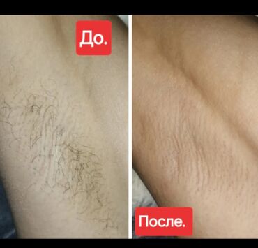 лазерная эпиляция затылка: Мом менен эпиляция, Эркектердин эпиляциясы, Шугаринг, Үйгө баруу кызматы менен