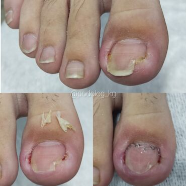 Маникюр, педикюр: Коррекция вросших ногтей, Педикюр, Услуги подолога, Консультация, Одноразовые расходные материалы — 8