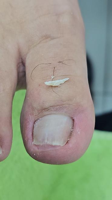 Маникюр: 📢акция с ! Вросший ноготь 📍подологический педикюр,👣 📍мозоли — 2