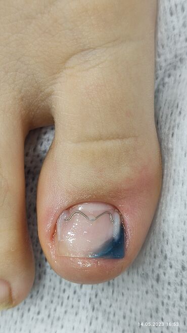 Маникюр, педикюр: Коррекция вросших ногтей, Маникюр, Педикюр, Услуги подолога, Консультация, Одноразовые расходные материалы — 13