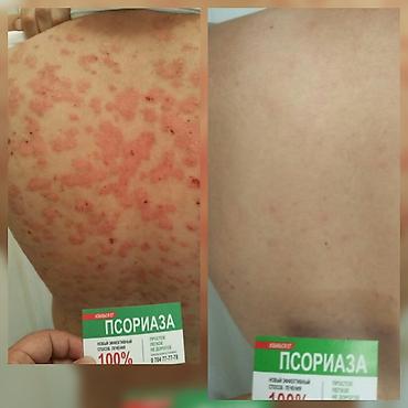 мазь cortam: Здравствуйте! Найден эффективный способ от Псориаза. Я сам болею этой — 3
