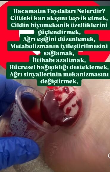 капельницы уколы на дому: Hicama, bankoterapiya və zəli terapiyası xidməti Təklif olunan