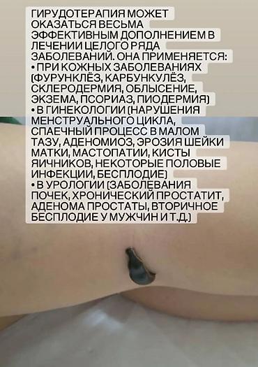 лечение варикоза: Врачи | Гирудотерапевт | Лечение пиявками — 8
