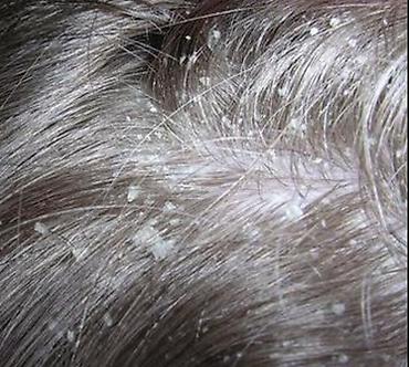 Hello Hair Anti-Dandruff Shampoo – Golden Pearl • Məhsul növü: Kəpəyə