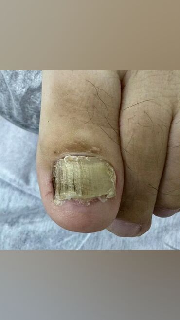 Маникюр, педикюр: Коррекция вросших ногтей, Маникюр, Педикюр, Услуги подолога, Консультация, Одноразовые расходные материалы — 8