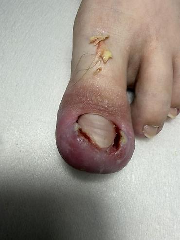 Маникюр: Коррекция вросших ногтей, Услуги подолога, Одноразовые расходные материалы — 5