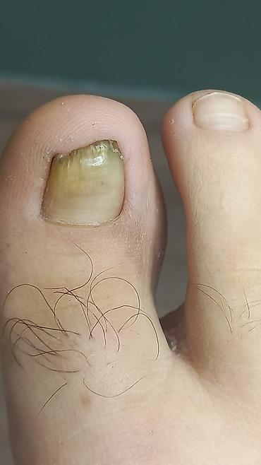 натижной паталог: Подологическая услуга: обработка и лечение проблемного ногтя на — 1