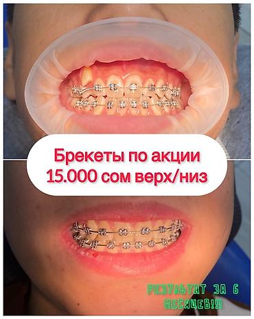 Работа: Брекеты за 15 000 сом. В чем подвох?» Ни в чем. Просто лечение на — 1