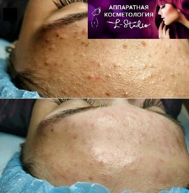 хиджама лица: Косметолог | Чистка кожи | Консультация, Гипоаллергенные материалы, Сертифицированный косметолог